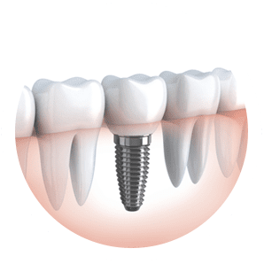 Dental Implants Cost Sydney