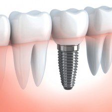 Cheap-Dental-Implants-Sydney