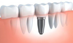 Cheap-Dental-Implants-Sydney
