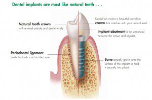 Affordable Dental Implants in Sydney