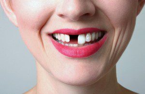 Risks of overseas dental implants