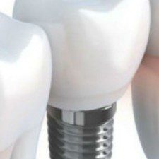 Urban Dental Implant Myths Exposed