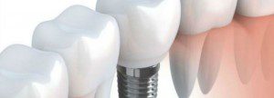 Urban Dental Implant Myths Exposed
