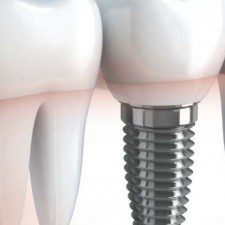 Benefits of dental implants