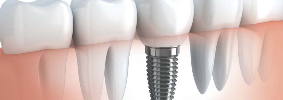 Benefits of dental implants