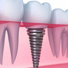 Disadvantages of Dental Implants