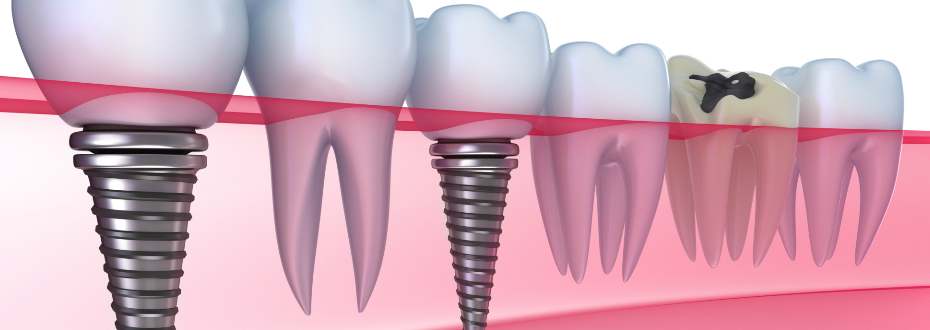Disadvantages of Dental Implants
