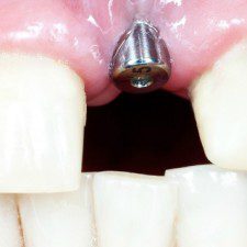 Facts about Tooth Implants