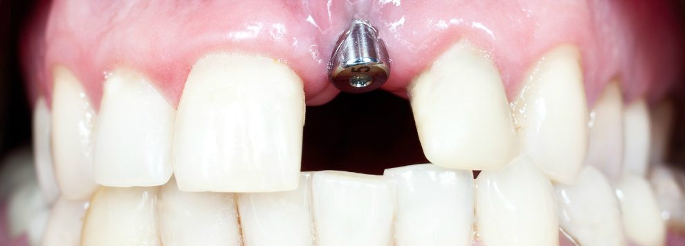 Facts about Tooth Implants