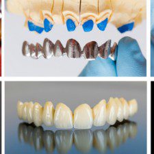 Denture Function