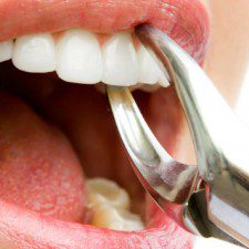 Recovery Tips for Wisdom Teeth Removal
