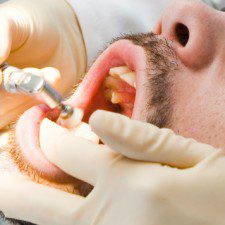 Candidate for Dental Implants Best Candidates for Dental Implant Procedures