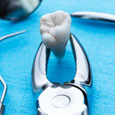 Wisdom Teeth Removal Cost