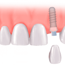 Dental Implant