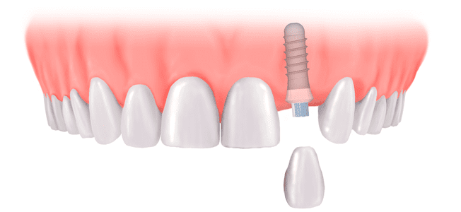 Dental Implant