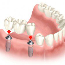 Dental Implants