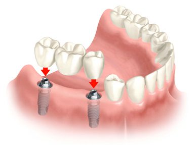 Dental Implants