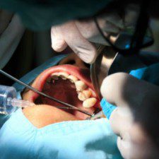 Foods to Avoid After Wisdom Tooth Removal