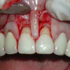 Teeth Surgery
