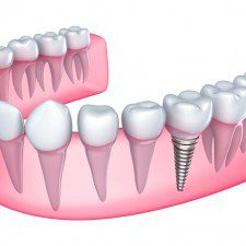 dental implant