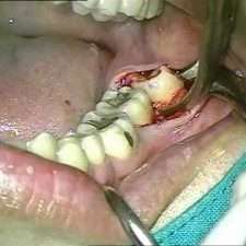 Teeth Removal