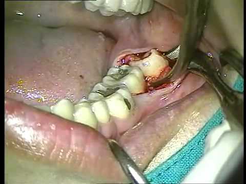 Teeth Removal