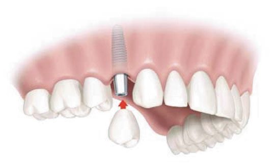 tooth implant