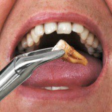 Teeth Removal