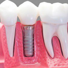 dental implants