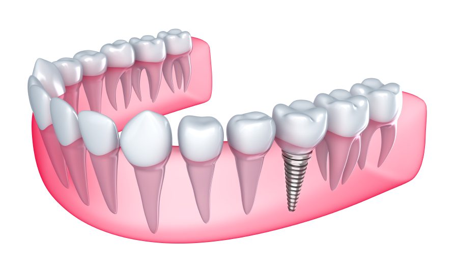 tooth implant