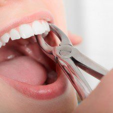 Wisdom Teeth Extraction you must know about