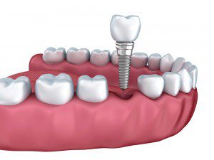 Brief Focus about Dental Implants