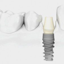 Tooth-Implants-Doubts Tooth Implants Doubts
