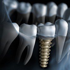 Prepare for Dental Implants Procedure with these 6 Expert Tips