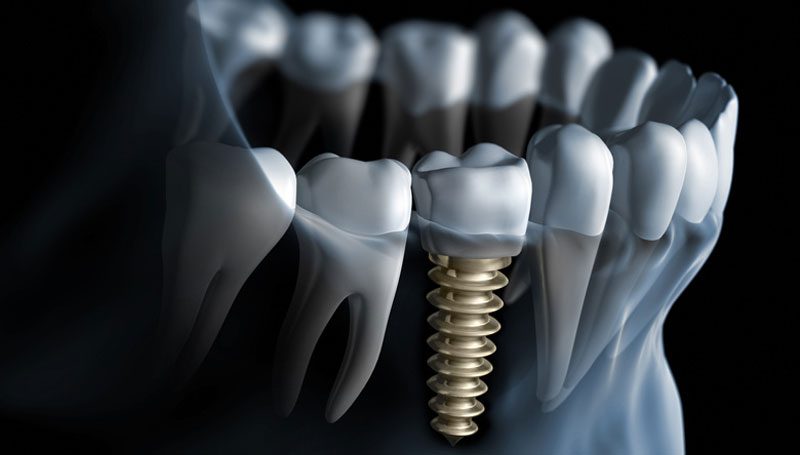Prepare for Dental Implants Procedure with these 6 Expert Tips