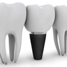 4 Essential Facts You Should Know Before Getting Dental Implants