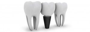 4 Essential Facts You Should Know Before Getting Dental Implants