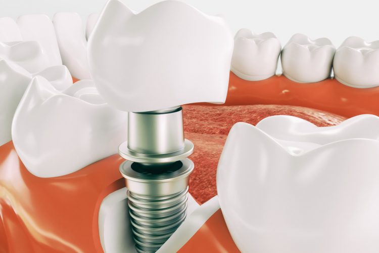 Dental Implant Recovery