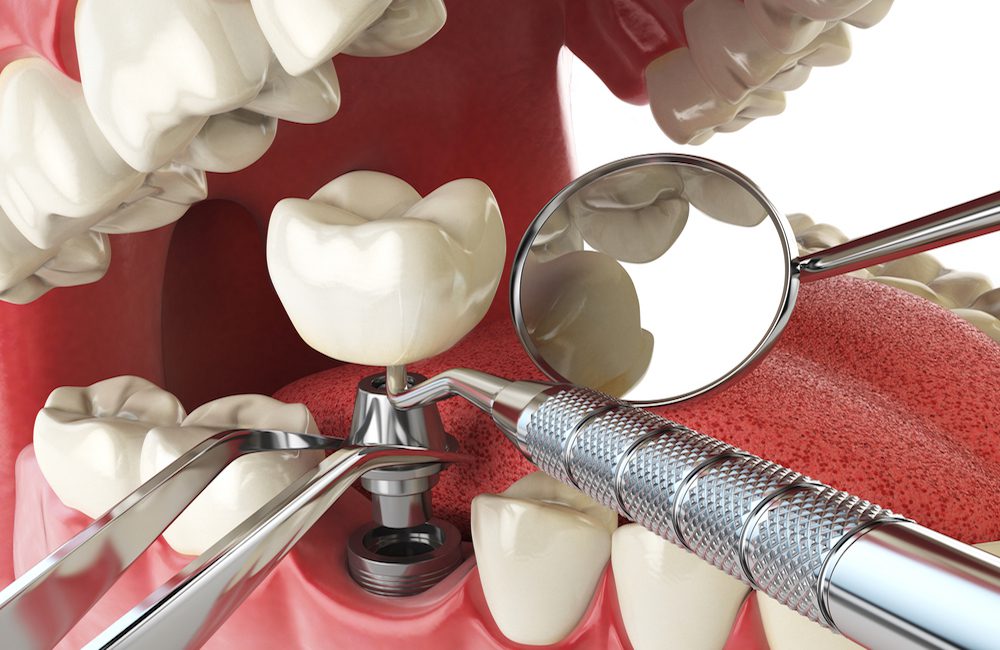 Dental Implants: Step by Step Procedure