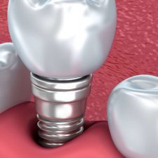 Tooth Replaceent Solution