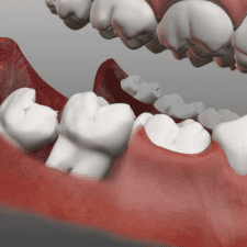 4 Appealing Attributes of Good Quality Dental Implants