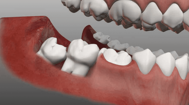 4 Appealing Attributes of Good Quality Dental Implants