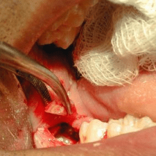 Wisdom Teeth Needs To Be Removed Properly