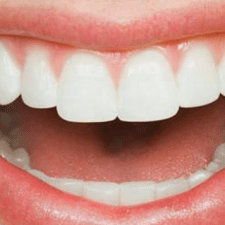 Bring Down Dental Implants Failure