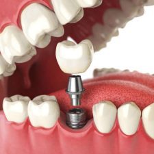 Dental Implants Sydney Dental Implants Sydney