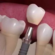 dental implant