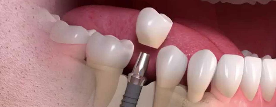 dental implant