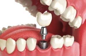 4 Appealing Attributes of Good Quality Dental Implants