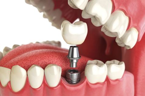 Dental Implants Cost in Sydney