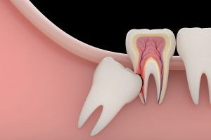 Know About Wisdom Teeth